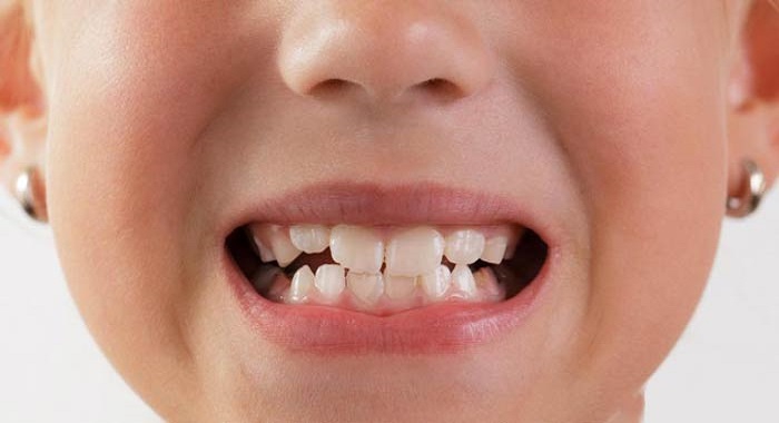 علت دندان قروچه در کودکان به هنگام خواب و در بیداری